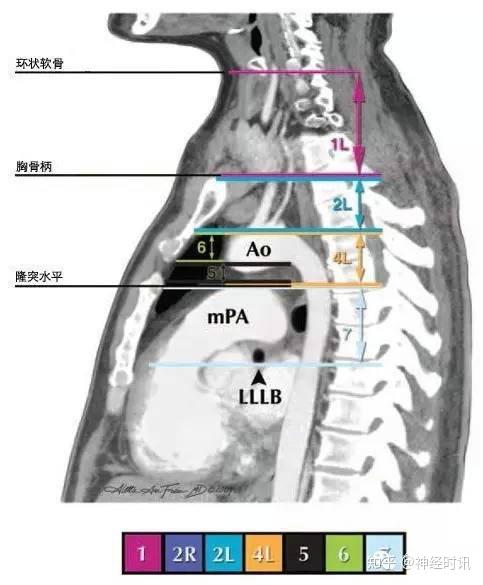 隆突下食管旁淋巴结(第8组) 肺韧带淋巴结(第9组) 肺门淋巴结(第10组