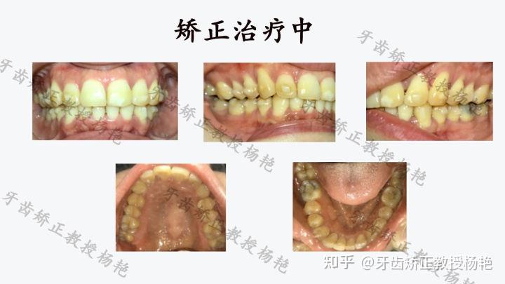 武汉牙齿矫正丨牙齿隐形矫正牙列拥挤深覆合病例