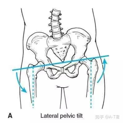 首先我们要先找到几个重要的骨性标志:髂棘,髂前上棘和髂后上棘.