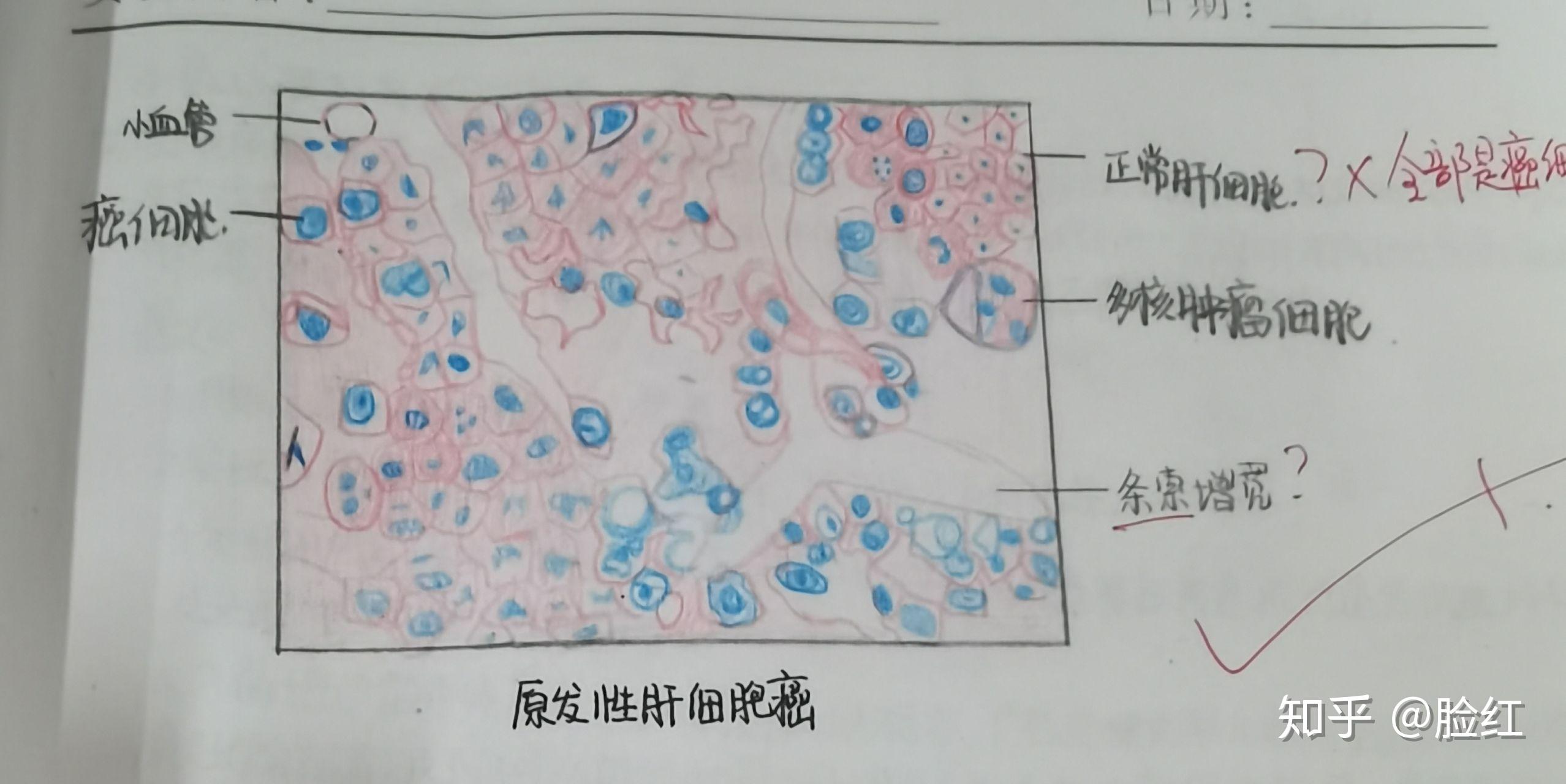 肿瘤淋巴结结合肝脓肿蜂窝织性阑尾炎炎性细胞3.