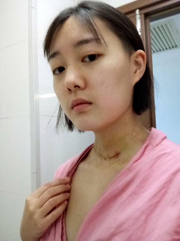 21岁甲状腺乳头状癌患者的真实经历(二)