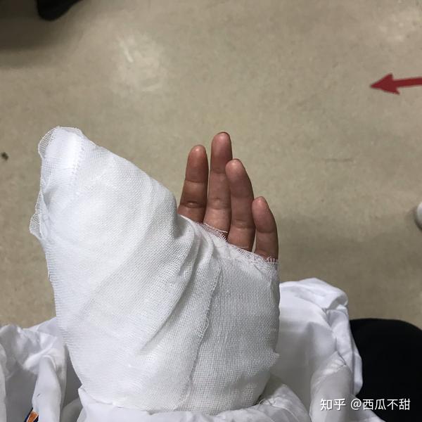 记录一下手指肌腱断裂恢复过程