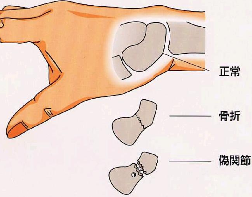 记骨折顺利康复舟状骨