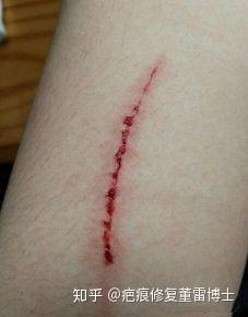 《疤痕修复》如何处理伤口才能更快恢复和不留疤痕?
