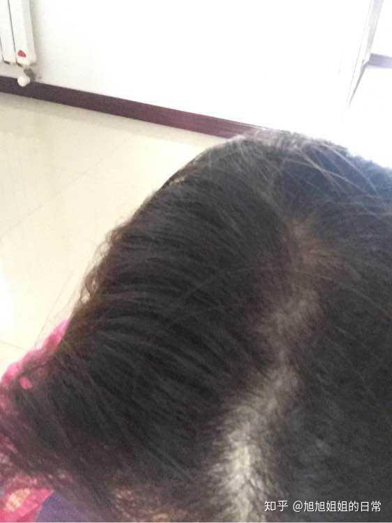 为什么老是掉头发是什么原因