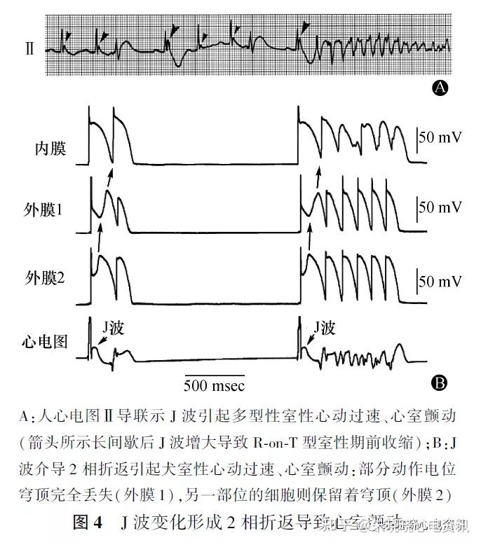 j波与心脏性猝死