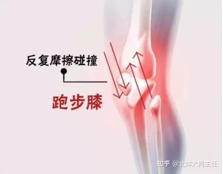 如何治疗髌腱炎