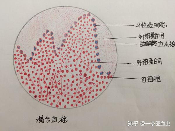 纤维素性心包炎