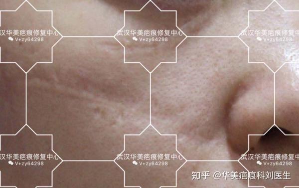 痤疮,手术,外伤,感染,水痘及天花等是常见的引起凹陷性疤痕原因