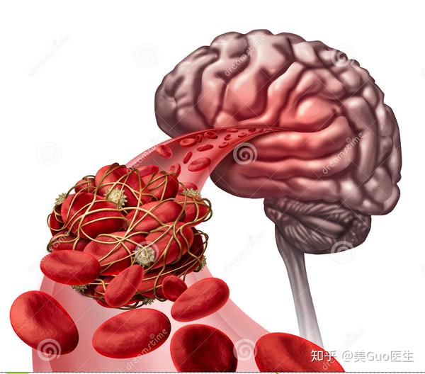 一生中最严重的头痛—"动脉瘤性蛛网膜下腔出血"