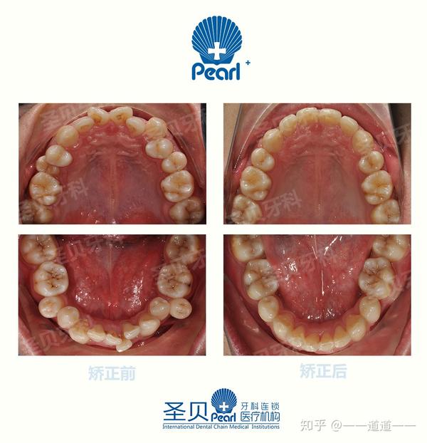 广州圣贝牙齿矫正案例分享:上下牙列不齐 个别牙反颌