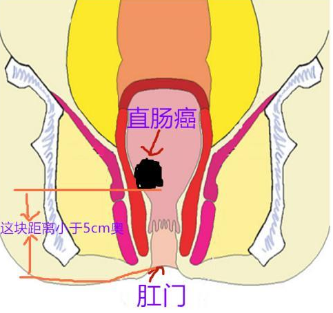 低位直肠癌能不能保肛如何保肛