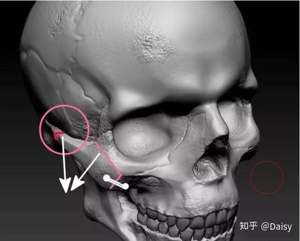 颧弓根部的截骨少量内推时,内推范围不超过颧弓根截面,要能接上才能