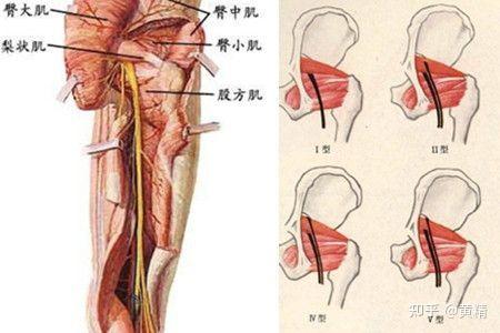 腰椎管狭窄和梨状肌综合征都有间歇性跛行症状如何鉴别