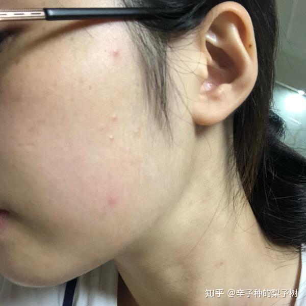 脸上长了很多又红又痒逆光疹子有些透明的尖头看起来油油的脂溢性皮炎