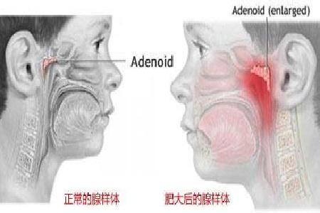 首大石萍:孩子腺样体肥大不一定非要手术 需权衡利弊