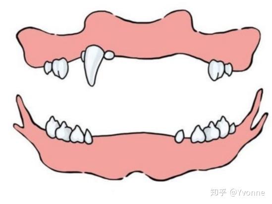 门齿脱落犬齿不齐(10–16岁)