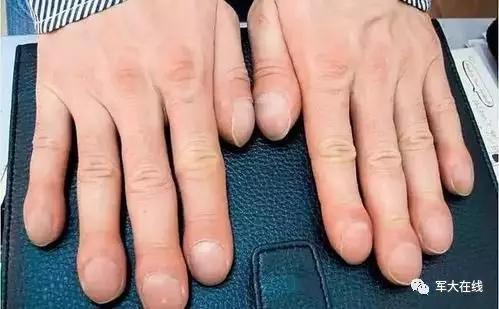 为什么有些人的手指像棒槌?哪些人会有杵状指?