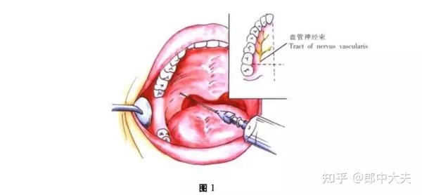 进针点:注射针自对侧口角向患侧腭大孔黏膜表面标志稍前内方为刺入点