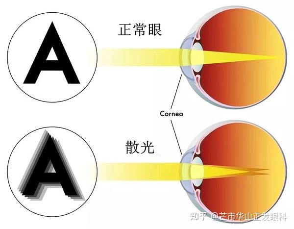 孩子看东西总是有重影到医院一检查既然是散光这是怎么回事