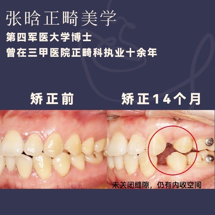 青岛牙齿矫正骨性牙性前突不手术正畸14个月改善嘴突