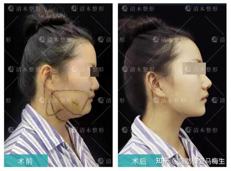 双下巴是怎么形成的怎么去掉双下巴