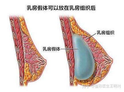 隆胸假体取出后可以直接做自体脂肪丰胸吗?