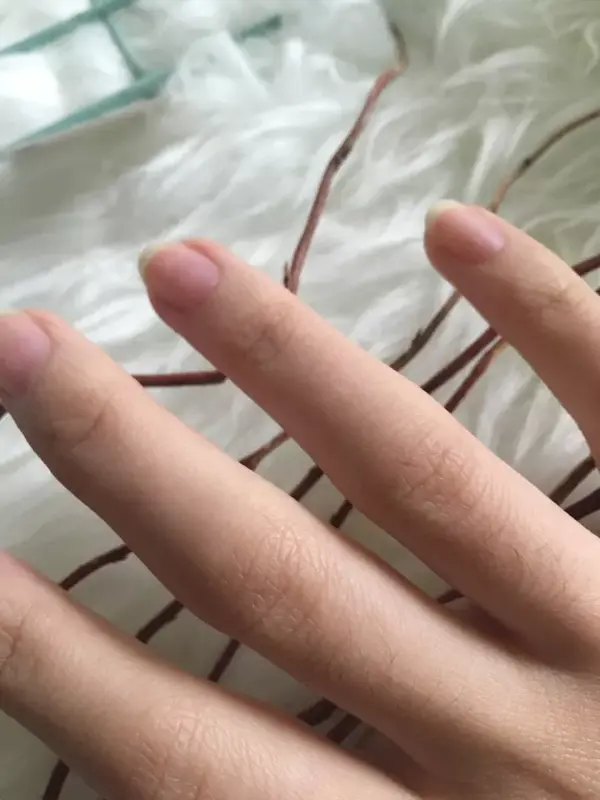 闲人徐大姨给对激光脱毛完全摸不着头脑的朋友