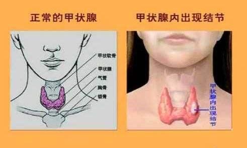 甲状腺知名教授孟宪华提醒广大甲状腺结节患者不要瞎吃小心病情加重