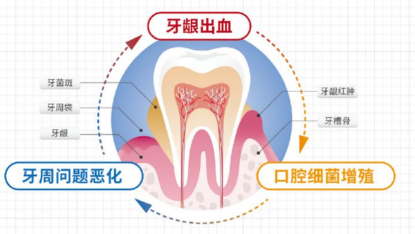 牙周病的表现