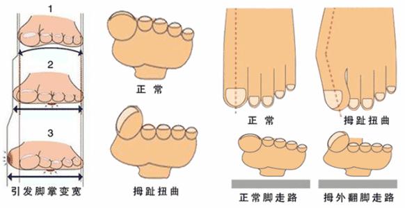拇外翻经常脚疼的人该注意了
