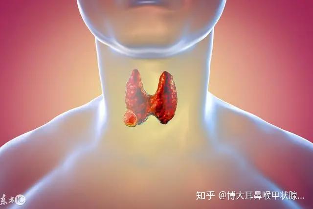 查出甲状腺乳头状癌最好的治疗方式是什么