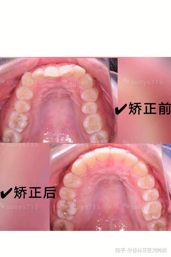 桂林正畸 | 深咬合牙弓狭窄