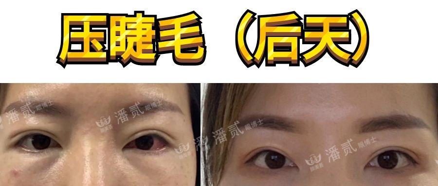 双眼皮手术压睫毛有何学问?