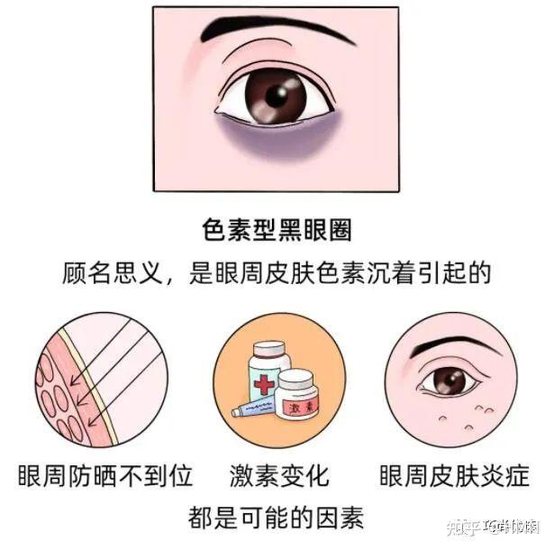 不熬夜作息健康为什么还是有黑眼圈