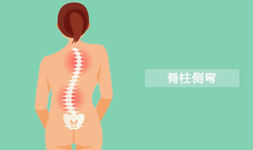 脊柱侧弯的5大常见误解(持续更新)