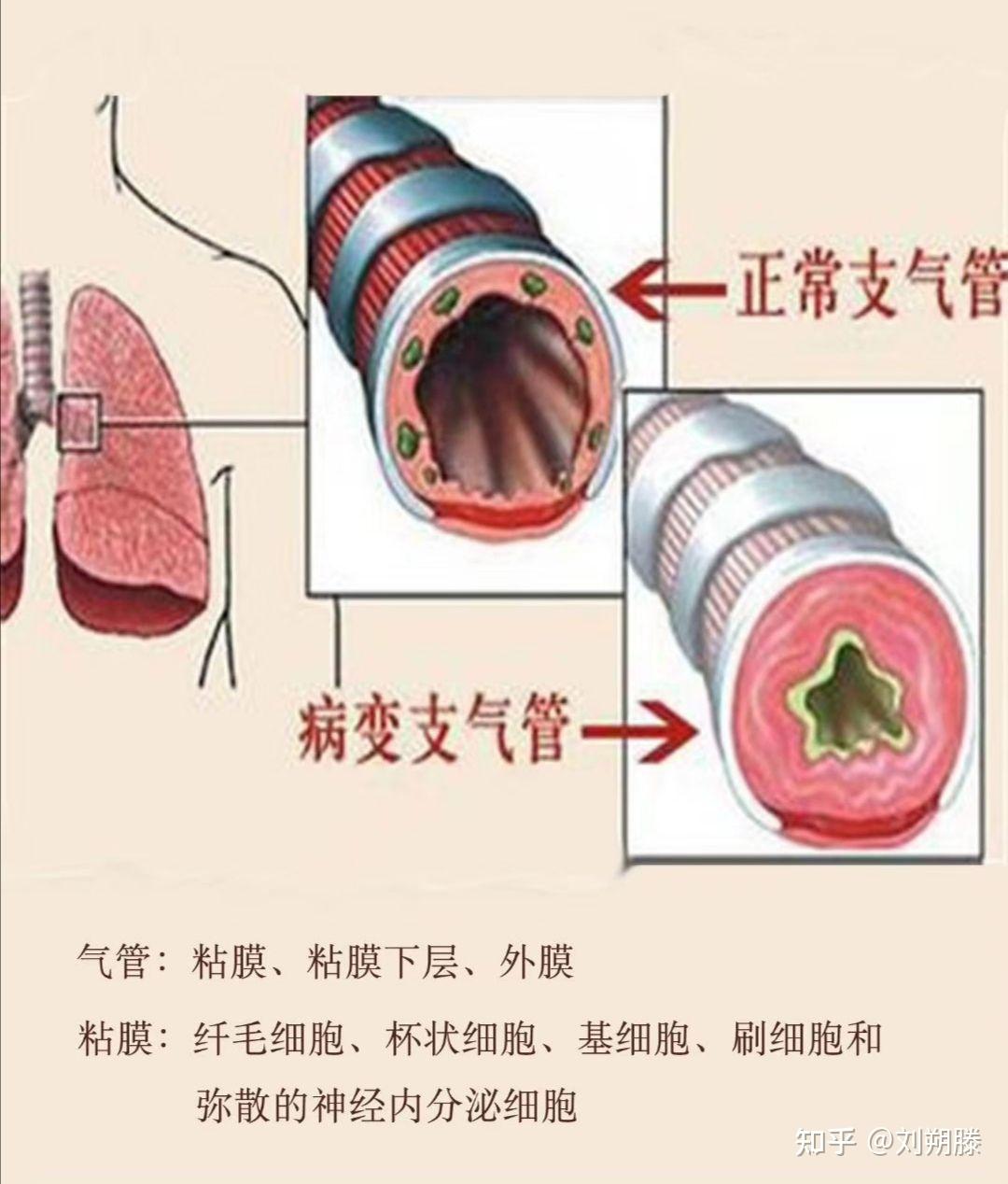 单纯型主要表现为咳嗽,咳痰;按症状可分为单纯型支气管炎与喘息型支