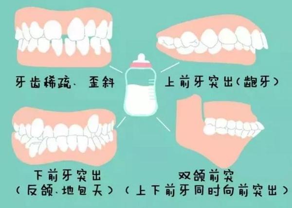 过度延长奶瓶的使用时间,和过度使用安抚奶嘴,吸吮手指一样,都会影响