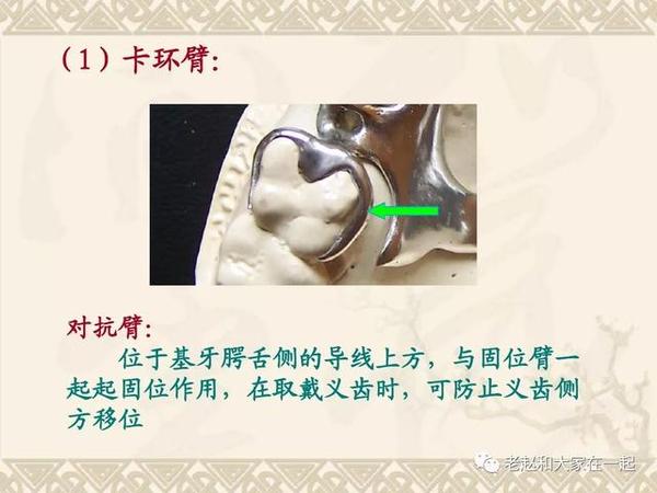 决胜2020医考│五星难度口腔修复卡环设计题