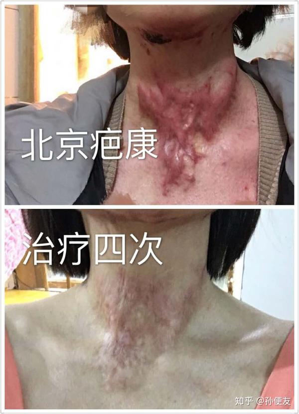 烧烫伤瘢痕有什么治疗方法?