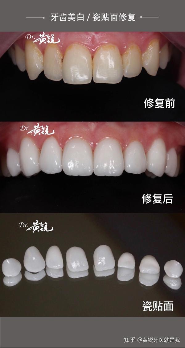 牙齿美白瓷贴面修复