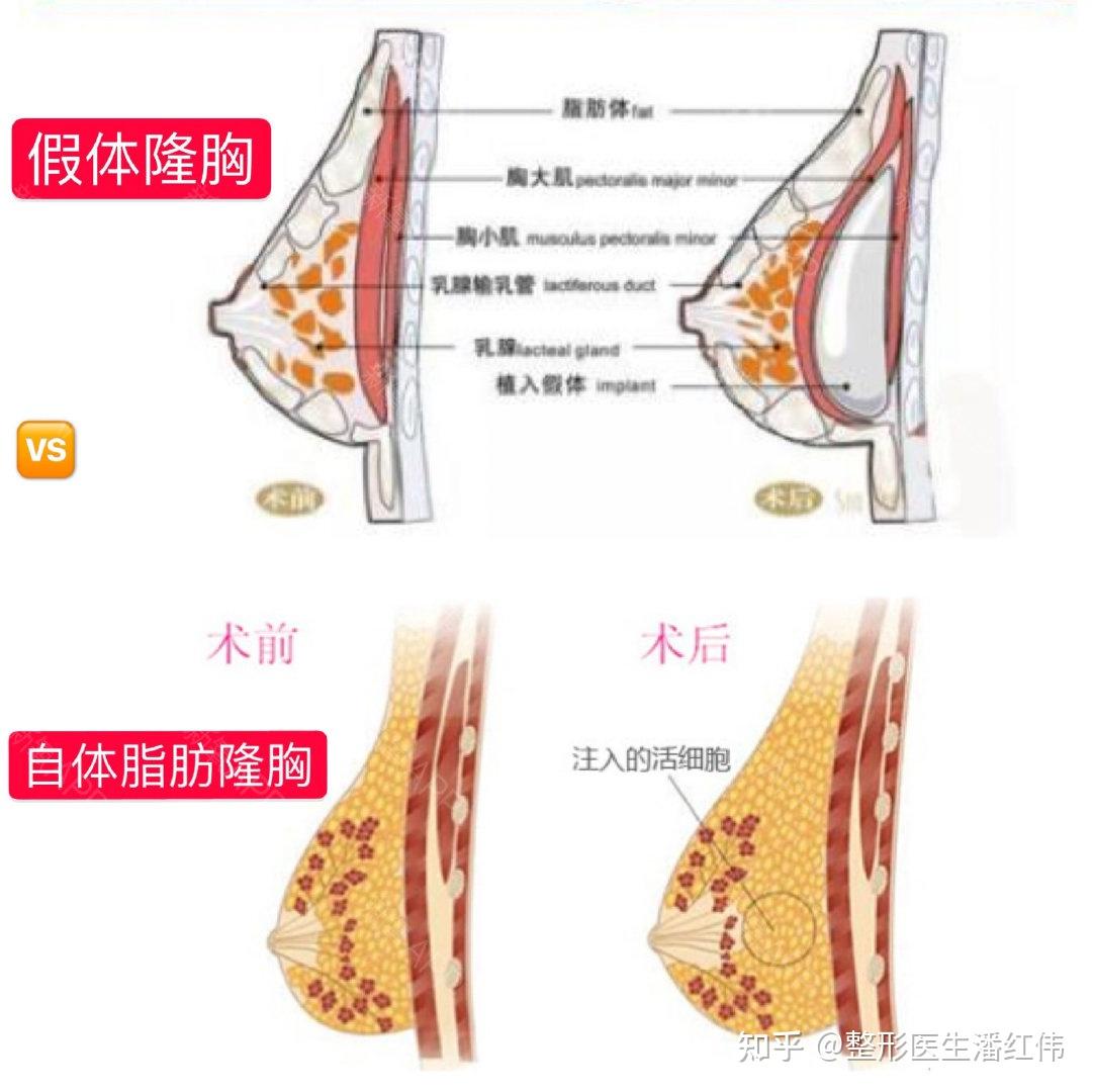自体脂肪丰胸自体脂肪隆胸是移植大腿,腰腹等部位堆积较多的脂肪