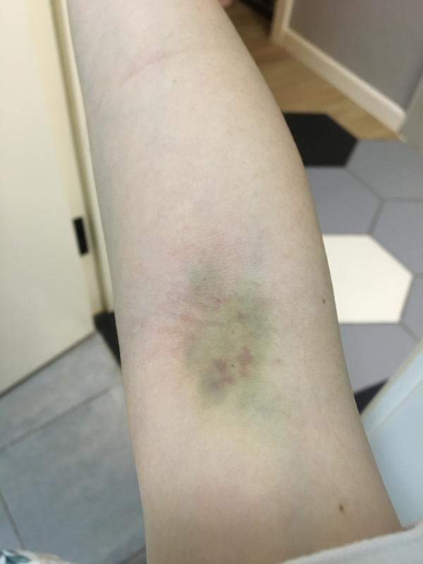 留置针拔掉后惨不忍睹的双手