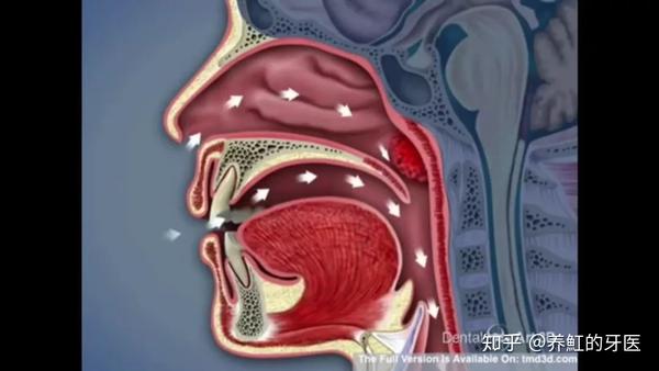 认识口呼吸造成的腺样体面容