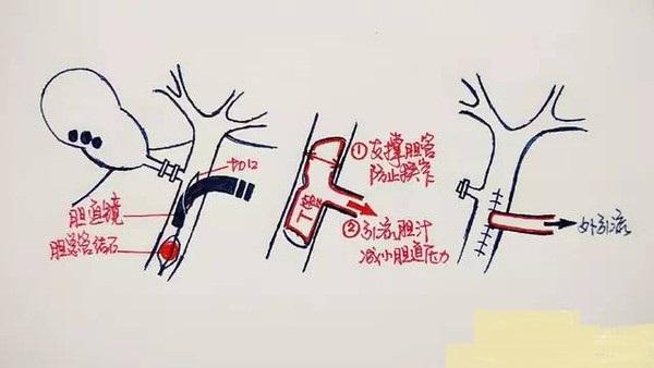 t管什么时候可以拔?自己的胆汁可以喝吗?