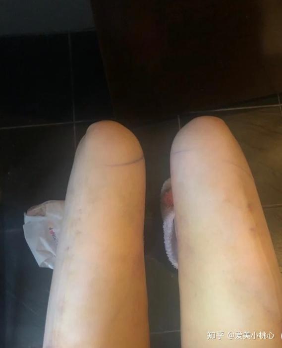 成都大腿环吸术后大腿吸脂术前准备吸脂护理吸脂注意事项一篇全解读