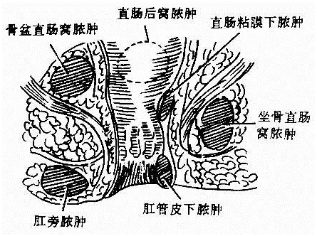 肛周脓肿术后注意事项