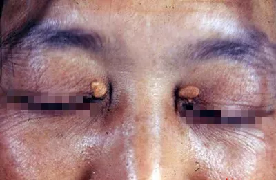 睑黄瘤为代谢障碍性皮肤病,是黄瘤病中最常见的一种.
