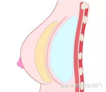 乳腺下,胸大肌还是双平面?讲讲隆胸假体植入层面