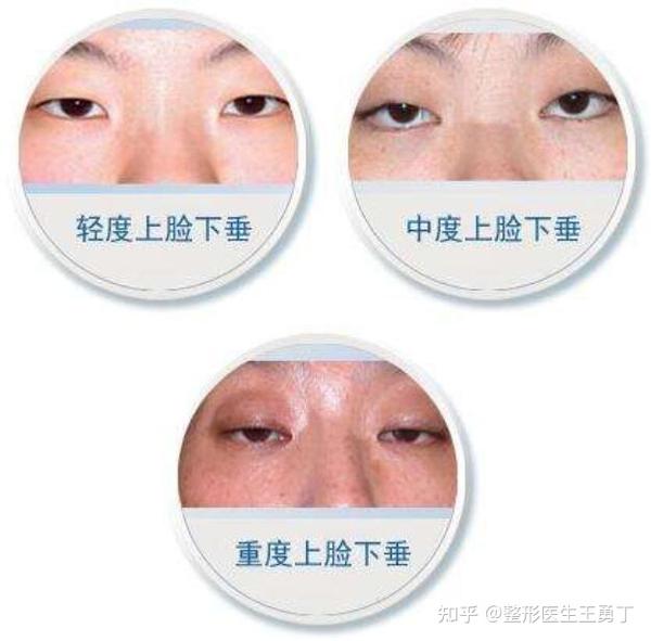 90%的人不知道上睑下垂到底是什么